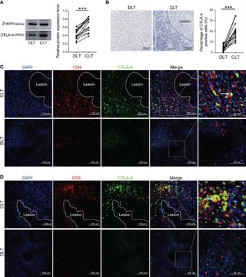 The expression of CTLA-4 in hepatic alveolar echinococcosis patients and blocking CTLA-4 to reverse T cell exhaustion in Echinococcus multilocularis-infected mice